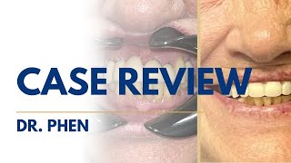 Full Mouth Restoration: Case Review | Dr. Phen