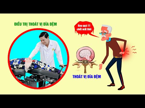 ĐIỀU TRỊ THOÁT VỊ ĐĨA ĐỆM - KHỎI BỆNH CHỈ TRONG MỘT LIỆU TRÌNH