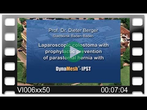 DynaMesh®-IPST - OR-Video: Laparoscopic Colostoma w. Prophylactic Prevention of Parastomal Hernia