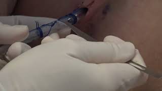 Chest tube removal