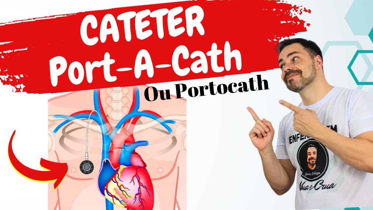 PORTOCATH ou Port- A- Cath ?   O que é? para que serve, Cuidados e Manutenção