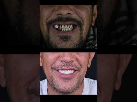 نتائج — زراعة الفك بالكامل