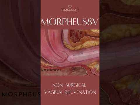 Non-surgical vaginal rejuvenation by Morpheus8V✨ #cosmeticsurgery #gynecologist #obgyn