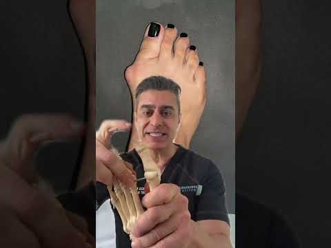 What is a bunion?