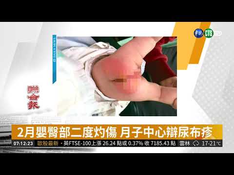 2月嬰臀部二度灼傷 月子中心辯尿布疹