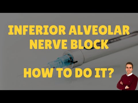 Inferior Alveolar Nerve Block: How To Do It?