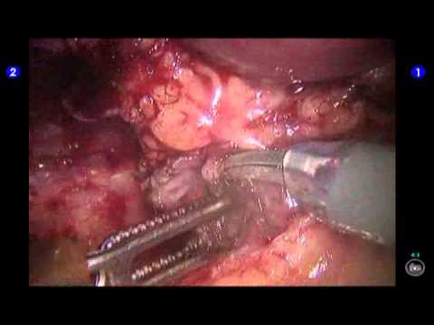 Robotic Treatment of Chyluria