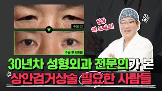 이런 눈이면? 상안검거상술 꼭 필요해요!