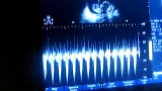 Heartbeat Audio 092309