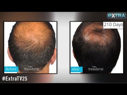 Experiencing Hair Loss? This FDA-Approved Helmet Uses Lasers to Stimulate Growth