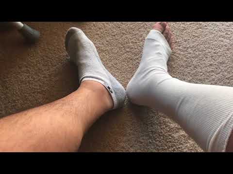 Achilles tendon rupture non op #1