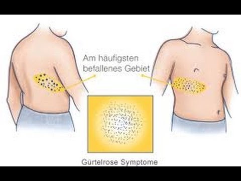Gürtelrose ist eine Viruserkrankung. Und was nun ?