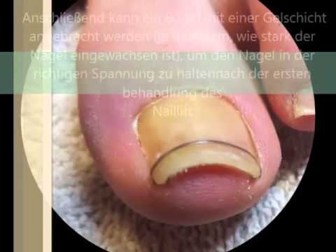 Gribok der Nägel bei den Kindern seit dem Jahr Wie den Nagel nach der Abtragung zu behandeln