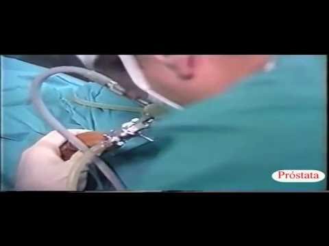 Oltre a sostenere prostata Difficoltà a urinare nel cancro alla prostata