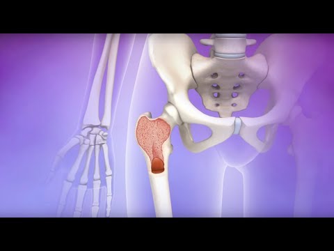 Myelofibrosis - Mayo Clinic