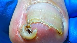 A Very Deep Ingrown Toenail, It Hurts Just Looking At It【Xue Yidao】