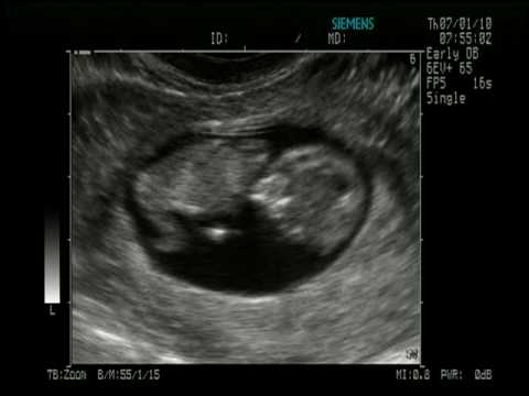 Pierwsze USG 10 tydzień i 4 dni - 7.01.2010 cz.2