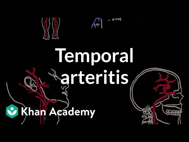 Video Pronunciation of temporal arteritis in English