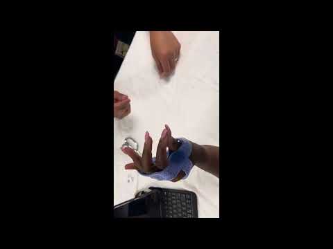 Anti-Claw Hand Orthosis including the Thumb