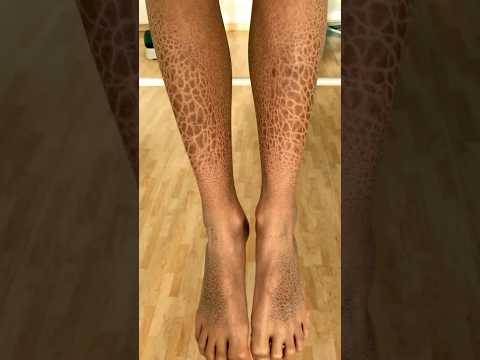 Dehydration & "Fish Skin" in Children | बच्चों में डिहाइड्रेशन