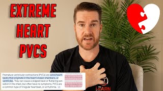 My Extreme Heart PVC Journey - Multiple Surgeries and How I Feel Now