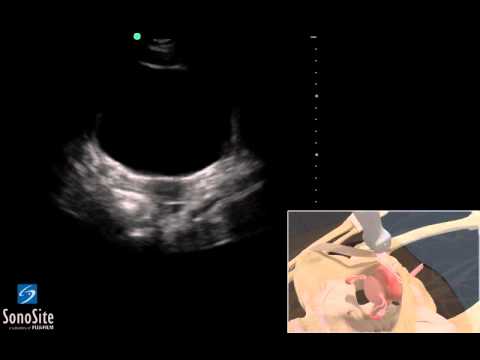 3D Lehrvideo: EFAST - Becken