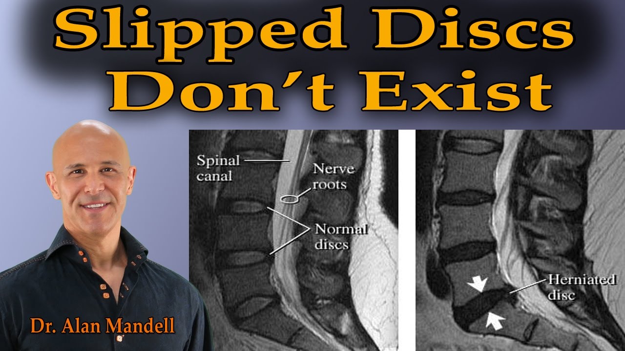 Why Slipped Discs Don't Exist - Dr Mandell - YouTube