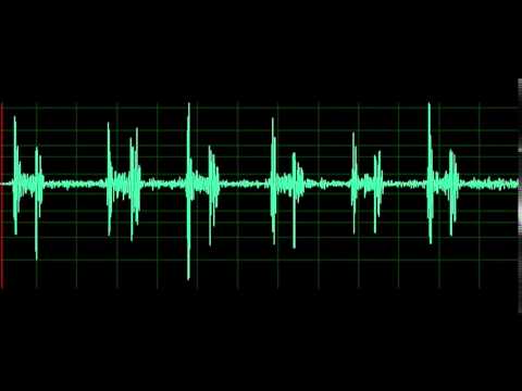 Pulmonary Associated Heart Sounds- Tricuspid Regurgitation