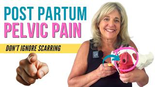 Labiaplasty for Pain and Irritation