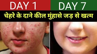 how to clear acne and pimples naturally ||कील मुंहासे और दानों को जड़ से खत्म करें।