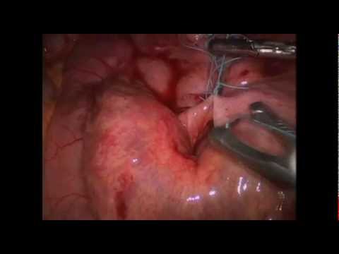 Laparoscopic Repair of Internal Hernia after RYGB