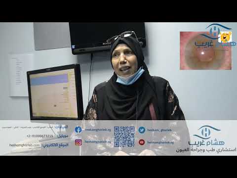 Cataract Patient Story 13