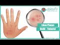 LİKEN PLANUS Liken Planus Nedir Liken Planus Tedavisi