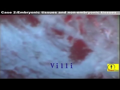 Abortion \(MTP Video, MTP Procedure\)