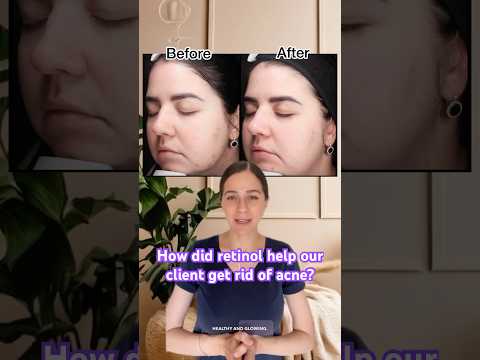 How does retinol actually fight breakouts? Amazing results revealed!
