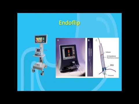 Chicago 4.0 The Latest Classification of Esophageal Motility Disorders