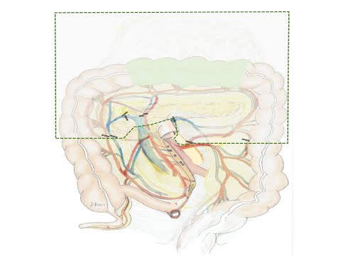 Laparoscopic CME with Removal of Gastroomental Package for Transverse Colon Cancer