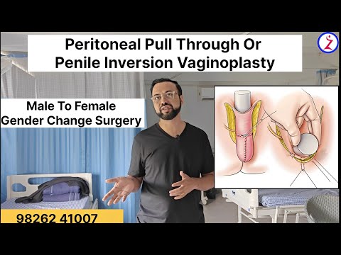 Male To Female Gender Change Surgery In India Delhi Mumbai Bangalore Kolkata Hyderabad Chandigarh