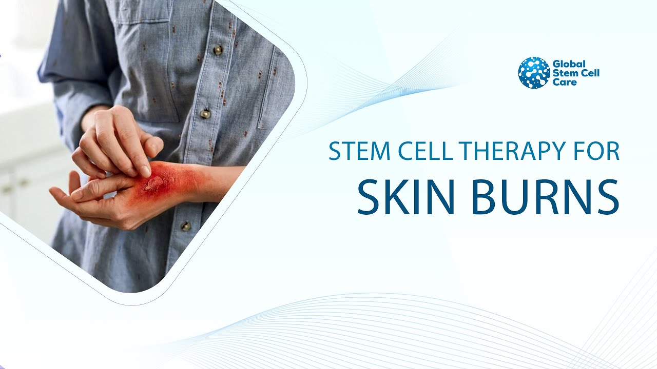 Skin Burns | Best Treatment For Skin Burns | Best Stem Cell Hospital For Skin Burn | Stem Cell