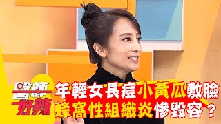 年輕女長痘痘用小黃瓜敷臉！「蜂窩性組織炎」慘毀容？【#醫師好辣】20260104 EP1766 part3