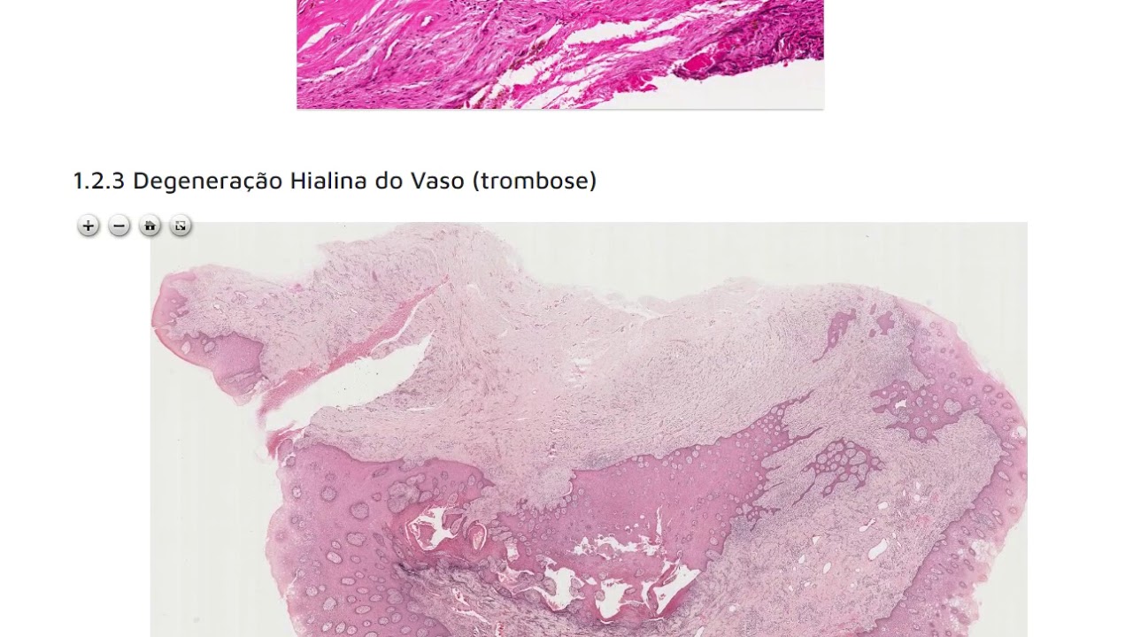 Prática   degeneração hialina e gordurosa