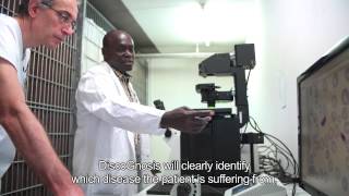 Lab-on-a-disc to diagnose Malaria