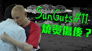 SunGuts#11 - 燒燙傷搶回生命後的漫漫長路