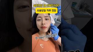 실 리프트 성형 시술