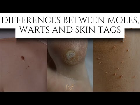 Differences Between Moles, Warts and Skin tags #skincare