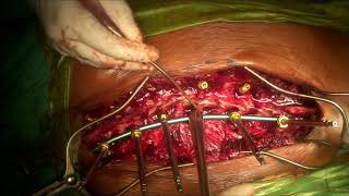 Posterior thoracic scoliosis surgery side loading set 2017