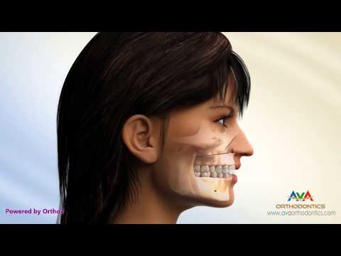 Surgical Orthodontic Treatment for Underbite or Crossbite - LeFort 1 Maxillary Advancement