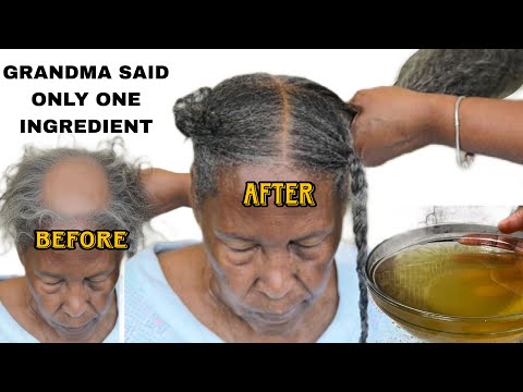 NO JOKE! I tried it! It works 💯! My hair Grew Back in 3 Weeks! Now my hair is thicker and longer! 