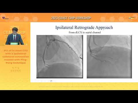 AUDITORIUM 2023 COACT CHIP WORKSHOP 1-4 PCI of in-stent CTO with a ipsilateral collateral 백주열