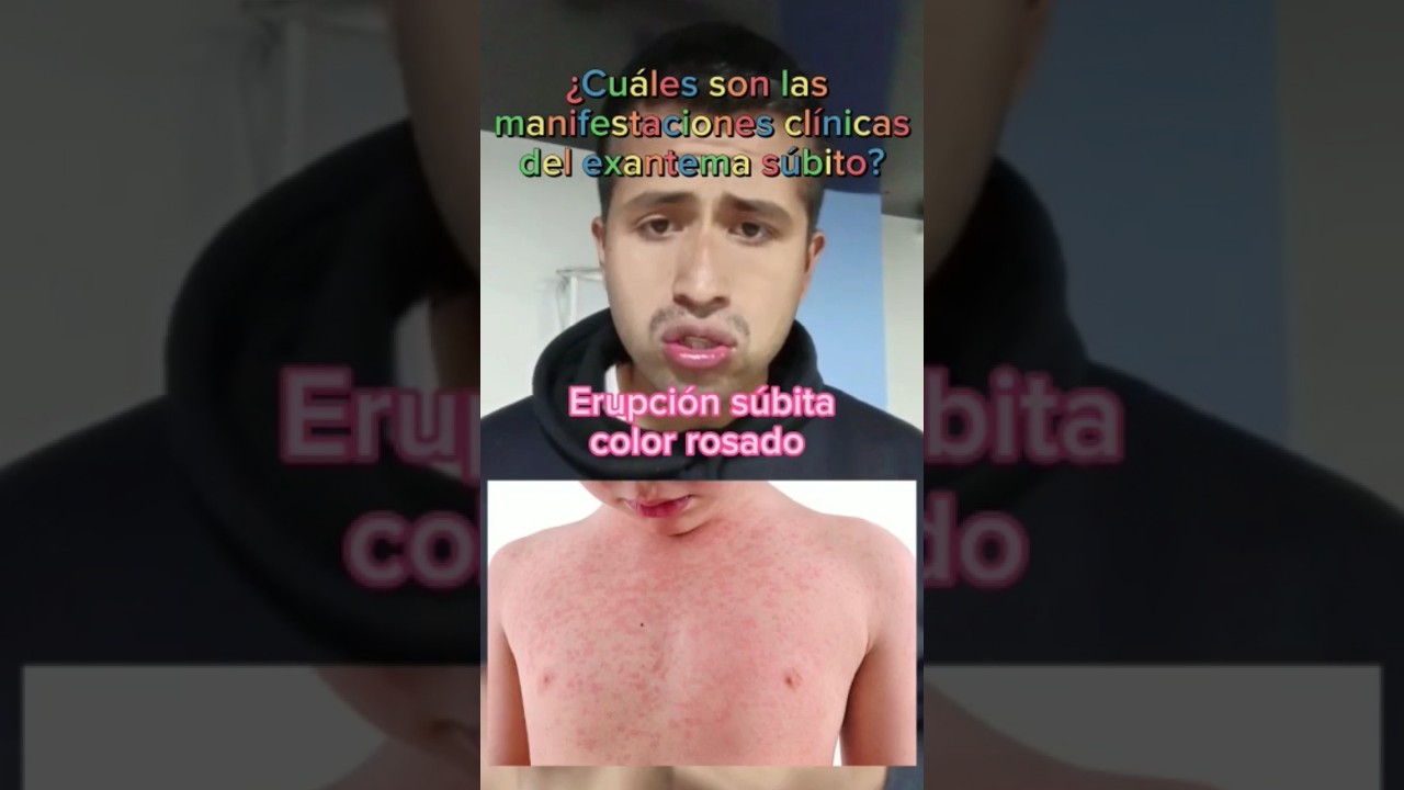 Síntomas del exantema súbito